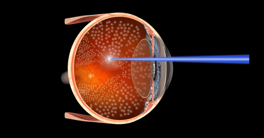 Panfotocoagulación. Tratamiento retinopatía diabética.