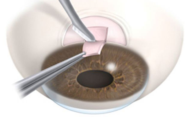 Trabeculectomía: cirugía del glaucoma