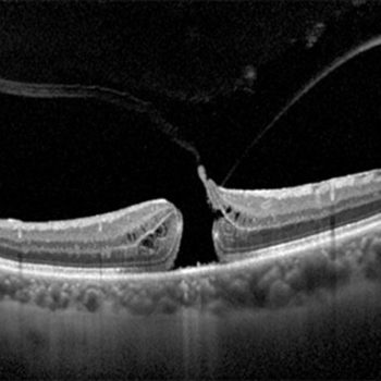 Agujero macular – rotura del tejido de la mácula. Agujero macular - rotura del tejido de la mácula.
