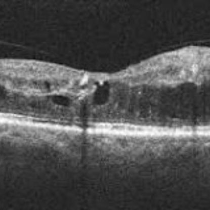 Tratamiento del Edema macular