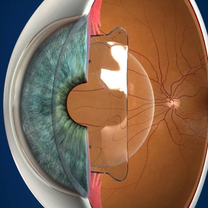 Lentes ICL o lentes intraoculares fáquicas Lentes ICL o lentes intraoculares fáquicas para corregir miopía o astigmatismo.