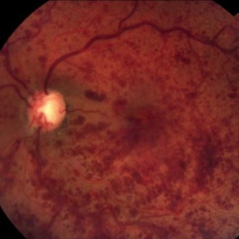 Oclusión venosa retiniana