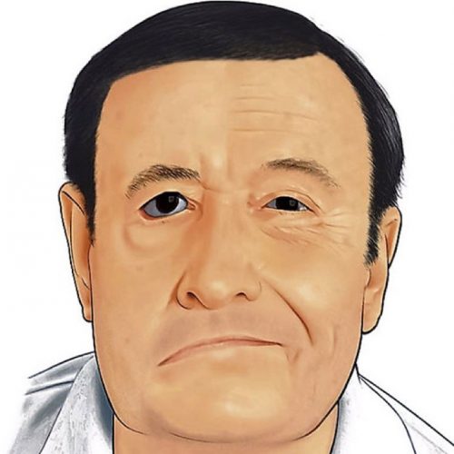 Parálisis facial Parálisis facial